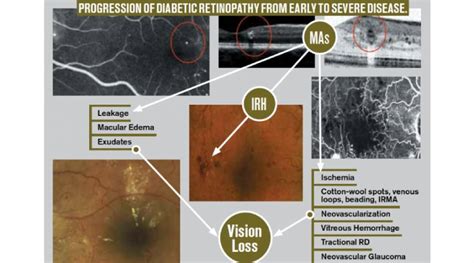 OphthalmologyNews | Treatment Strategies for Refractory Diabetic ...