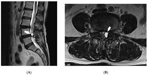 Medicina | Free Full-Text | Transforaminal Epiduroscopic Laser Ablation for Removal of a ...