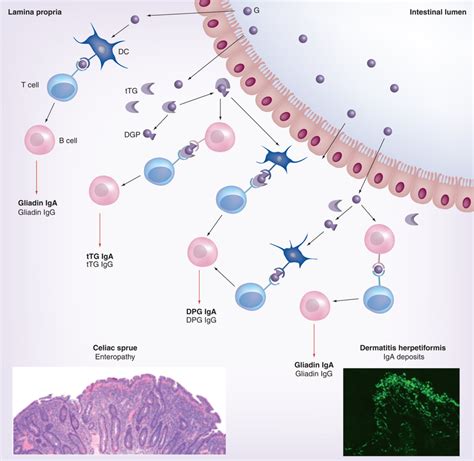 Pathogenesis of gluten-sensitive disorders | Download Scientific Diagram