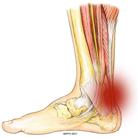 Achilles Tendon Injuries - Active Care