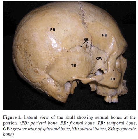 Unusual sutural bones at pterion