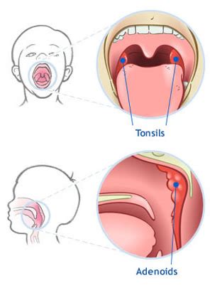 Tonsillectomy and Adenoidectomy - ENT