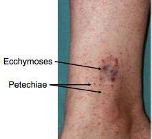 Petechiae, Purpura, and Vasculitis Flashcards - Cram.com