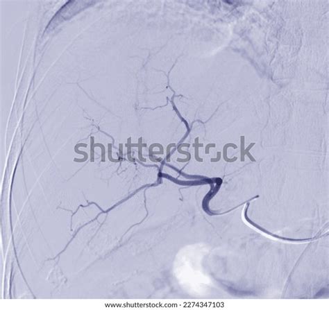 Imaging Tace Chemoembolization Procedure That Allows Stock Illustration 2274347103 | Shutterstock