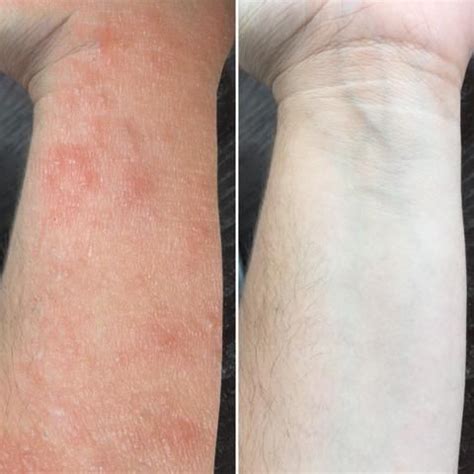 Before and After | Eczema, Photo, Users