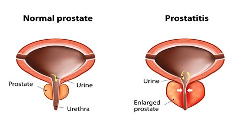 What is Benign Prostatic Hyperplasia (BPH)? | HALO Diagnostics