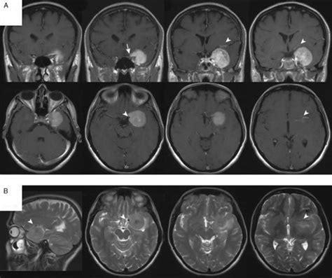 Sphenoid Wing Meningiomas | Clinical Gate