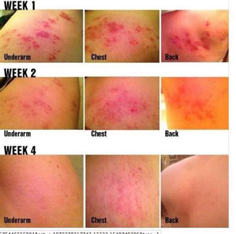 Shingles!!! Rodan and Fields Soothe Regimen has this affect on shingles. Wow! This was a clie ...