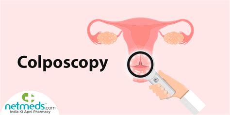 Colposcopy: Procedure, Risks And Results | Netmeds