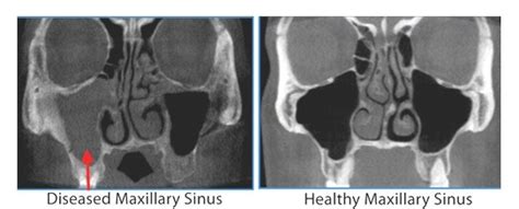 CT Scans (3-D Sinus Imaging) - ENT Florida