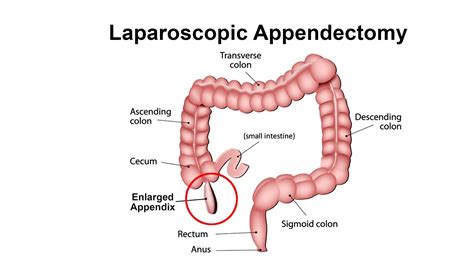 Laparoscopic Appendectomy for Enlarged Appendix - Unedited Video - YouTube