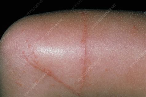 Larva migrans: skin rash due to hookworm larvae - Stock Image - M200/0098 - Science Photo Library