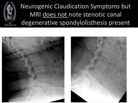 Neurogenic claudication symptoms