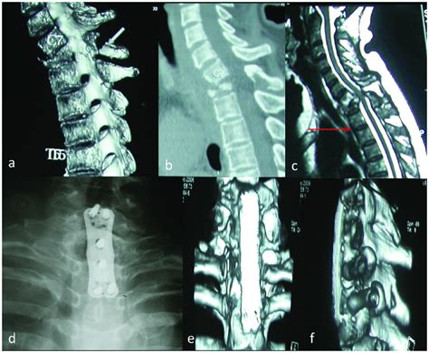 Another typical case for group A. A 45-years-old patient's preoperative... | Download Scientific ...