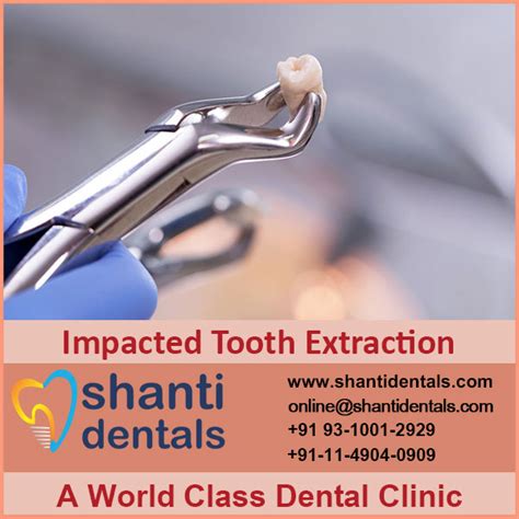 Impacted Tooth Extraction - Shanti Dentals