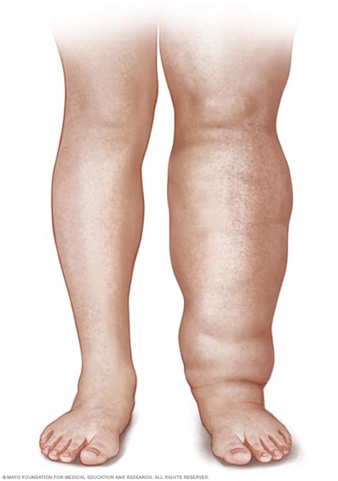 Leg lymphedema - Mayo Clinic