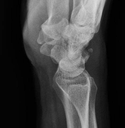 Triquetral fracture | Radiology Case | Radiopaedia.org