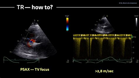 〖Echocardiography〗 Diastolic dysfunction VIII - how to measure 🫀 - YouTube