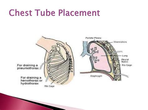 PPT - Chest Tubes PowerPoint Presentation - ID:3090007