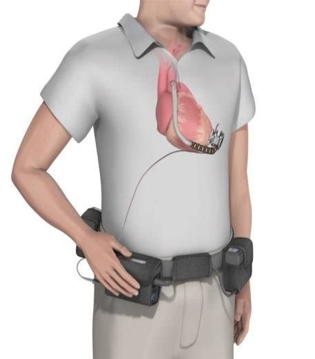 Centrifugal-pump 3 rd generation LVAD (HeartWare HVAD®) (A) Diagram of... | Download Scientific ...