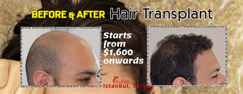 The Best FUE Hair Transplant Package in Istanbul, Turkey