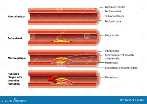 Plaque Formation In Artery Stock Photo - Image: 10836470