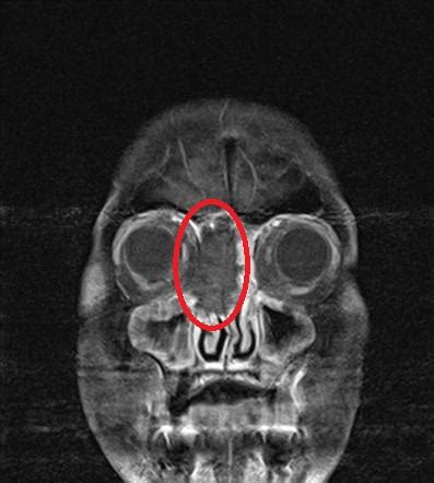 Mucormycosis MRI - wikidoc