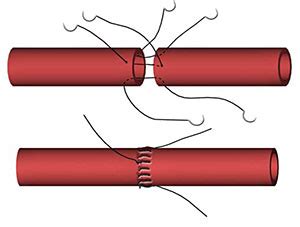 Vascular Anastomosis