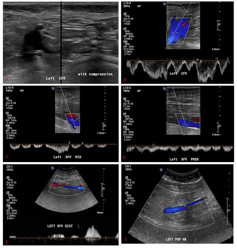 Lower Extremity Veins Ultrasound