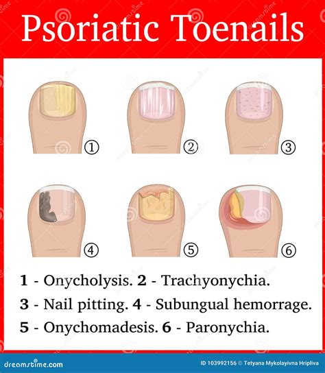 Illustration of Psoriatic Toenails Stock Vector - Illustration of ...