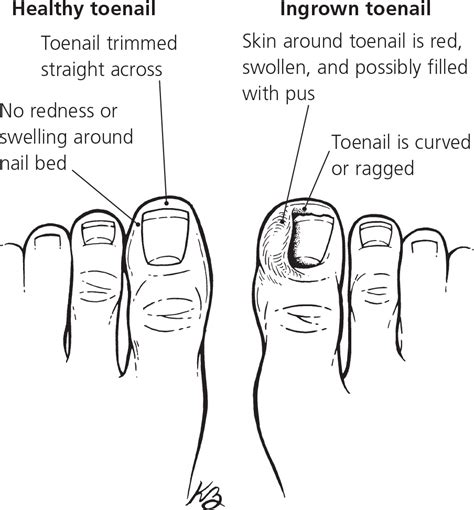 Ingrown Toenails | AAFP