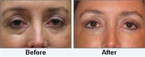 Carboxytherapy Services for Dark Under-Eye Circ...