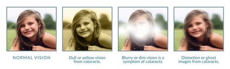 What should you do if you have cataract? - Evershine Optical