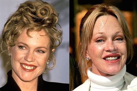 60 Worst Cases Of Celebrity Plastic Surgery Gone Wrong