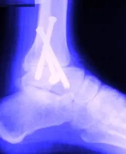 ANKLE SURGERY-Types of surgery for chronic ankle pain