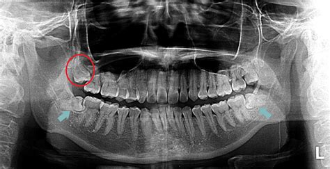 Is it Wise to Remove My Wisdom Teeth? - Medisave-Claimable for Surgery