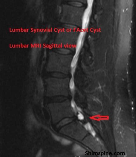 Synovial Cyst Lumbar Spine Removal - mapametawan