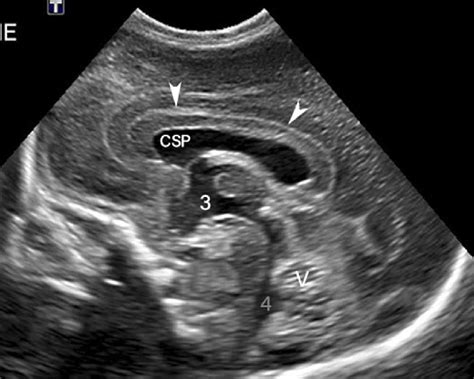 Normal head US in a preterm in sagittal plane through the midline. The ...