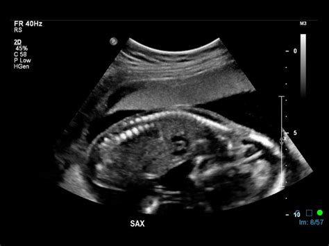 Fetal Presentation | BCPoCUS