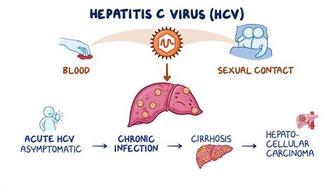 Hepatitis C: Clinical sciences - Osmosis Video Library