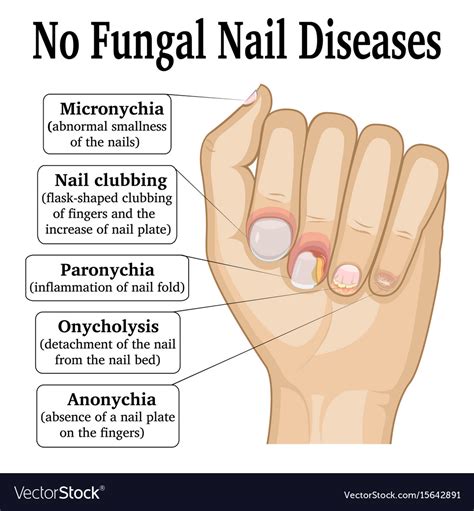 No fungal nail disease Royalty Free Vector Image