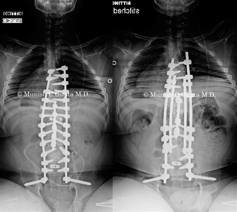 Neuromuscular/Congenital kyphosis | Munish C. Gupta, M.D.