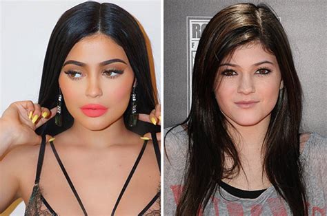 Kylie Jenner before surgery: Plastic surgeon gives verdict on starlet's ...