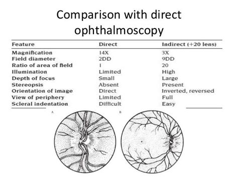 Indirect Ophthalmoscopy and slit lamp biomicroscopy