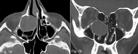 (a) (b) TC scan shows right maxillary sinus mucocele arose from the... | Download Scientific Diagram