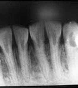 Case of the week: Dentin Dysplasia Type II – Dr. G's Toothpix