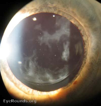 Atlas Entry - Posterior capsular opacity (PCO) following cataract surgery