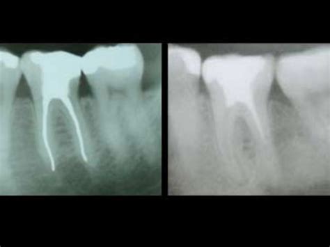 Complications of Root Canal Treatment | Denta Beaute Zahnmedizin