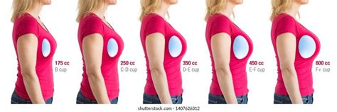 What happens after a breast reduction – Artofit