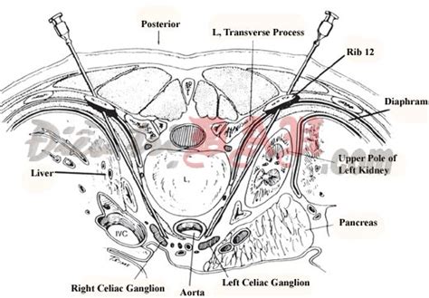 Celiac Plexus Block - Pain Management